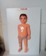 Polio